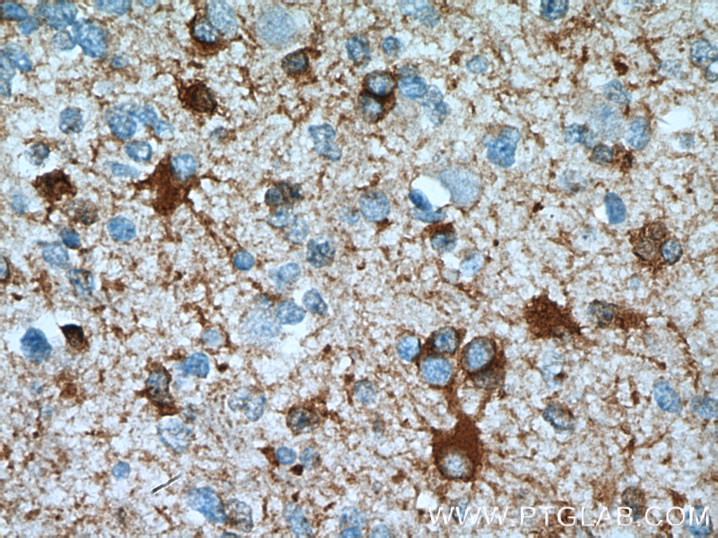 IHC staining of human gliomas using 17390-1-AP