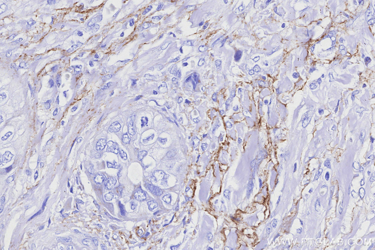 IHC staining of human pancreas cancer using 85980-2-RR