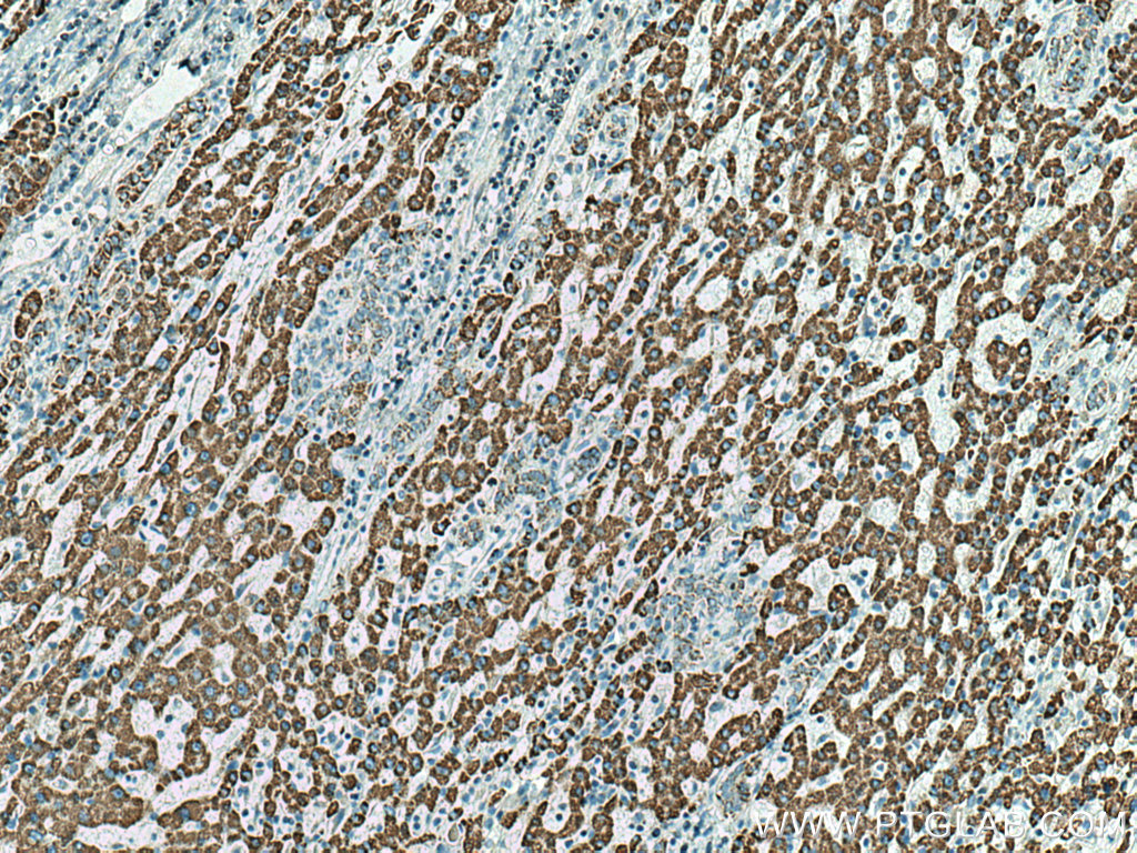 IHC staining of human liver cancer using 17319-1-AP