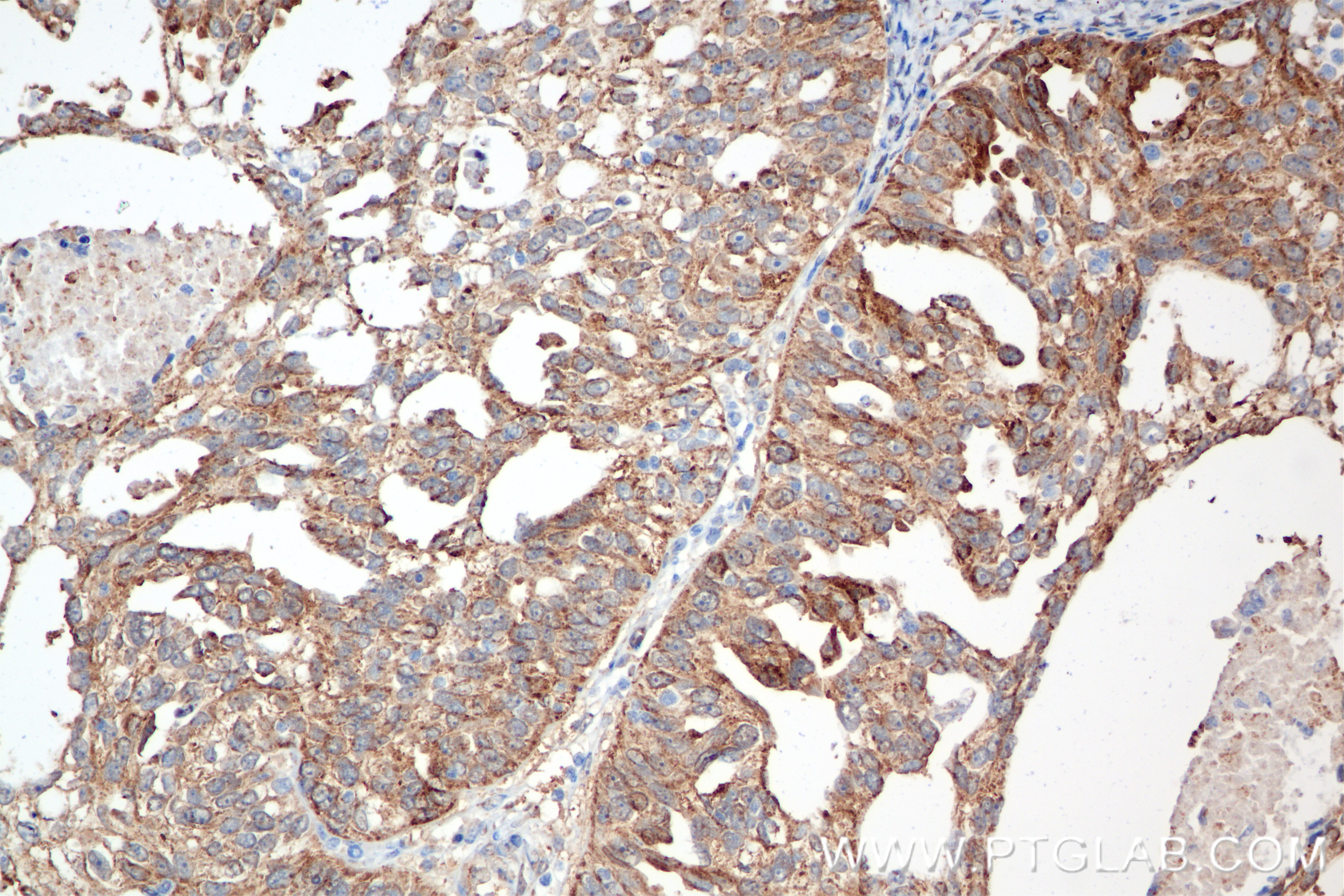 IHC staining of human ovary cancer using 84871-4-RR (same clone as 84871-4-PBS)