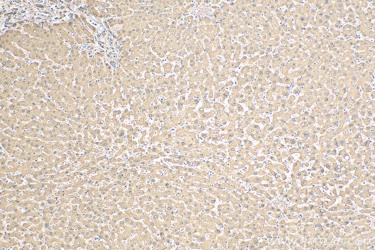 IHC staining of human hepatocirrhosis using 21602-1-AP