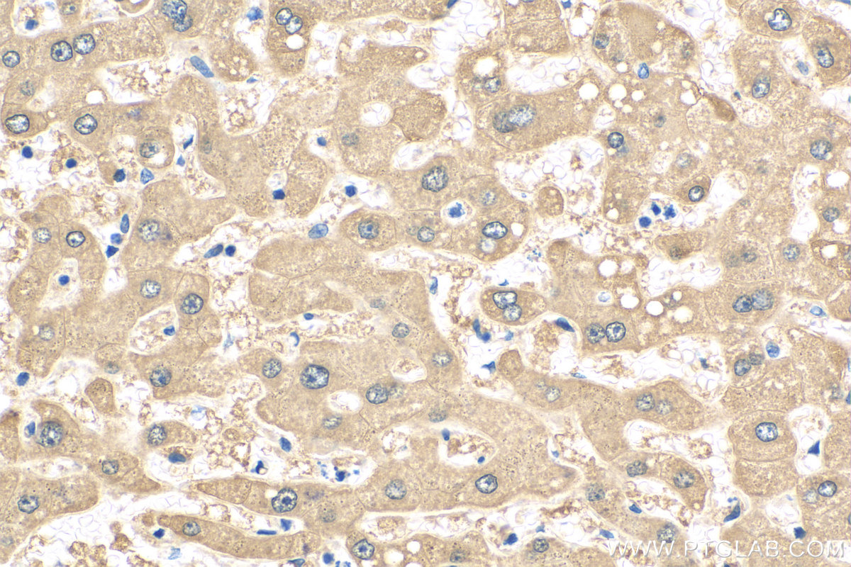 IHC staining of human hepatocirrhosis using 21602-1-AP