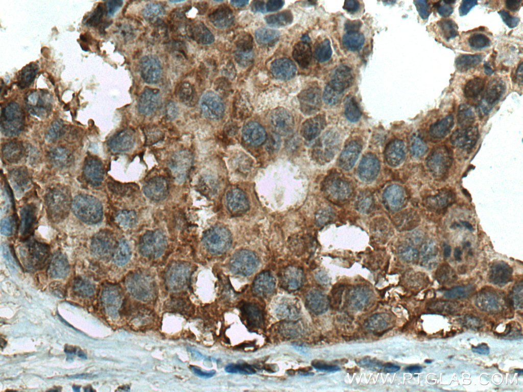 IHC staining of human breast cancer using 67372-1-Ig
