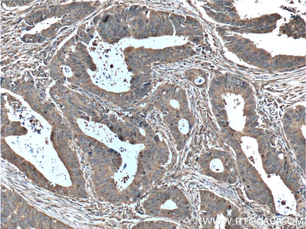 IHC staining of human colon cancer using 11217-1-AP