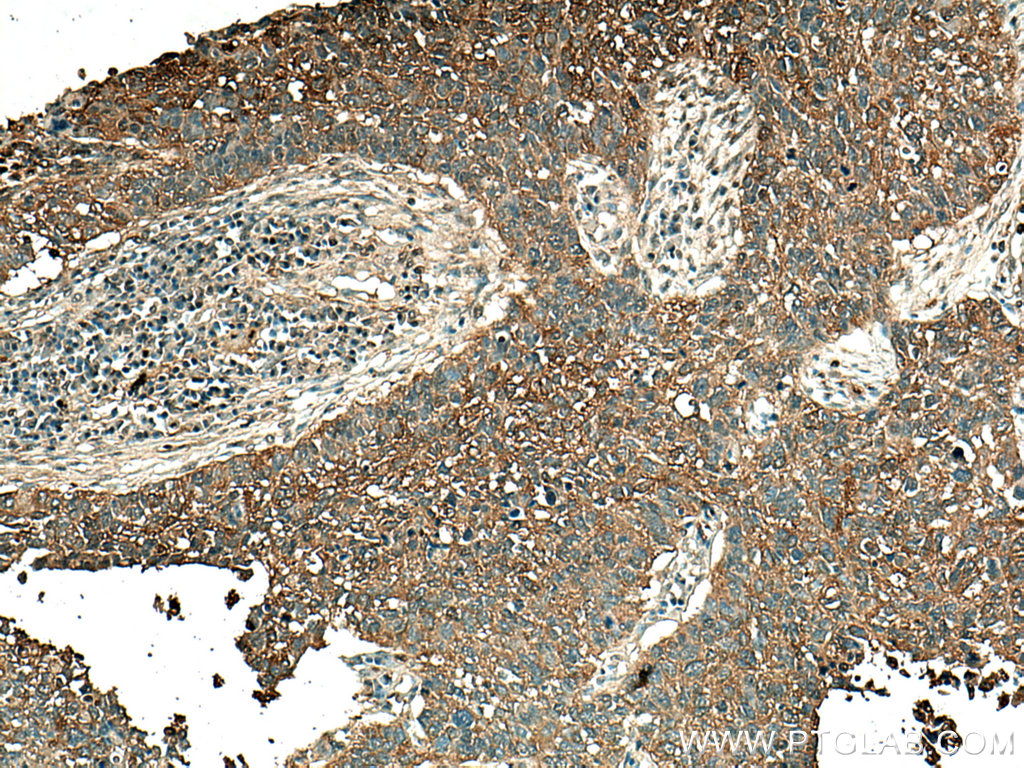 IHC staining of human lung cancer using 67453-1-Ig (same clone as 67453-1-PBS)