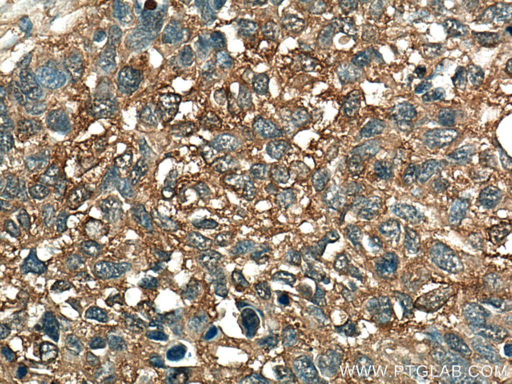 IHC staining of human lung cancer using 67453-1-Ig (same clone as 67453-1-PBS)