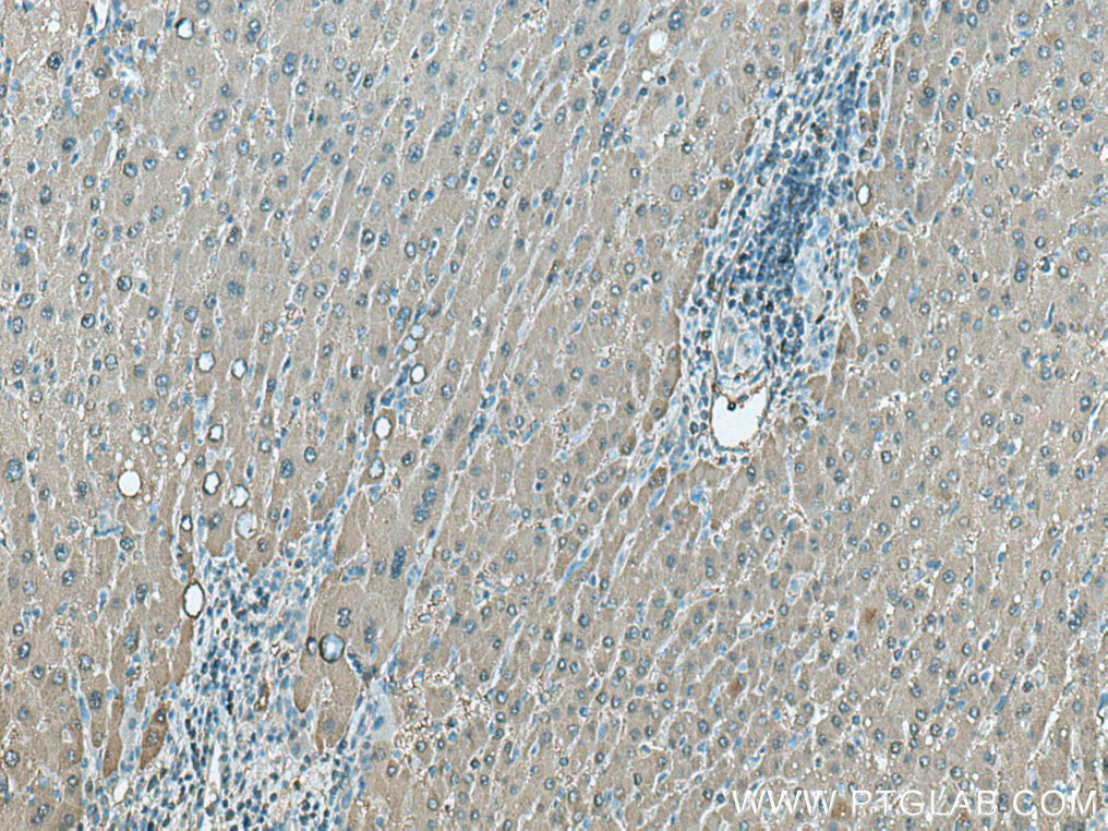 IHC staining of human liver cancer using 18065-1-AP