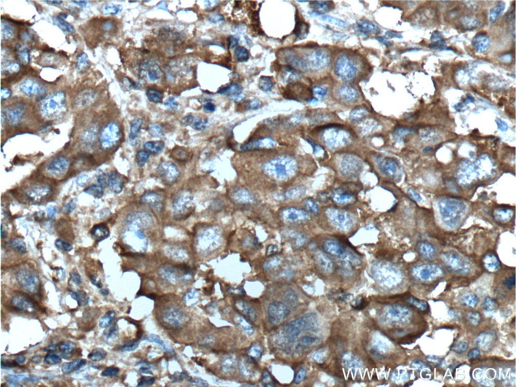 IHC staining of human liver cancer using 66120-1-Ig