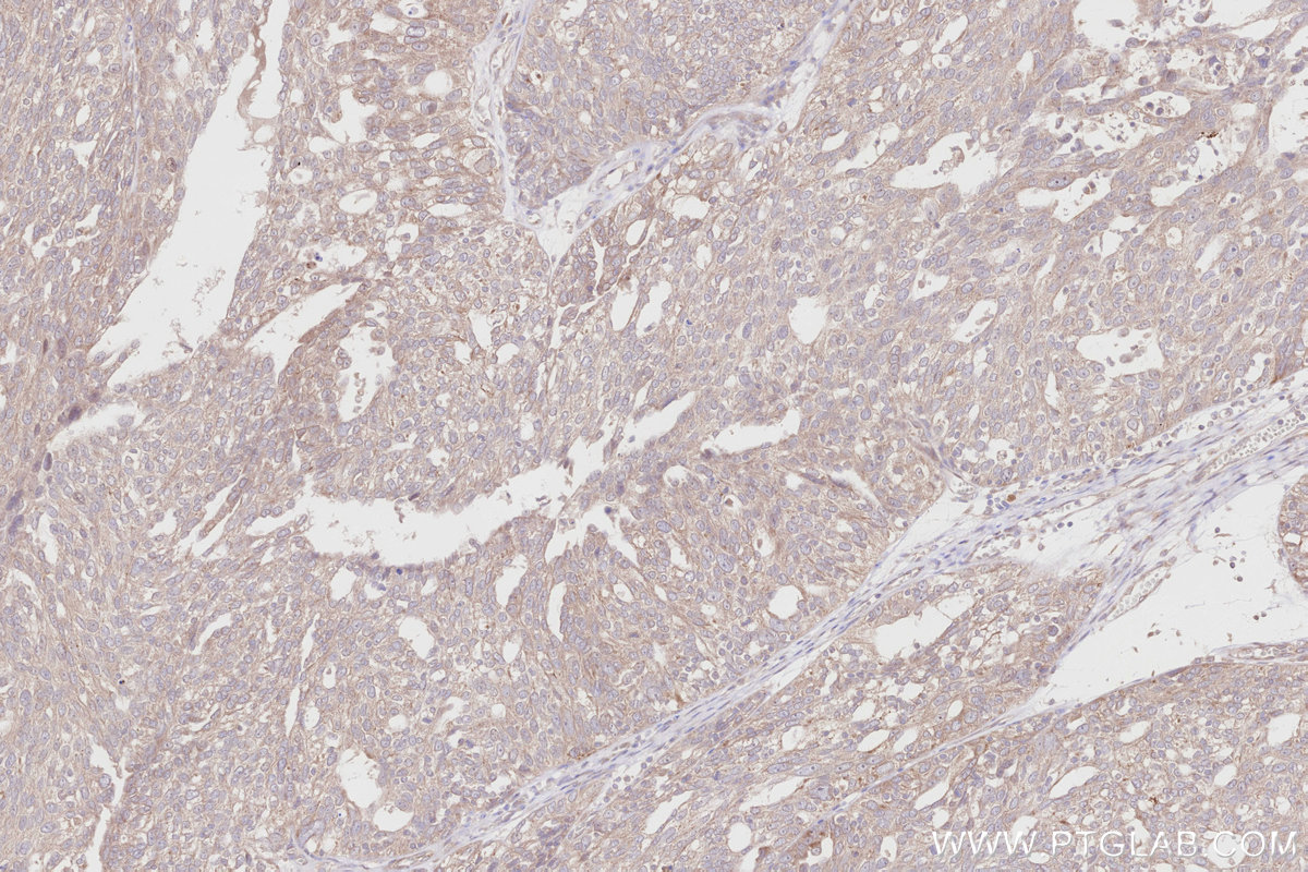 IHC staining of human ovary cancer using 12872-1-AP IHC staining of human ovary cancer using 12872-1-AP