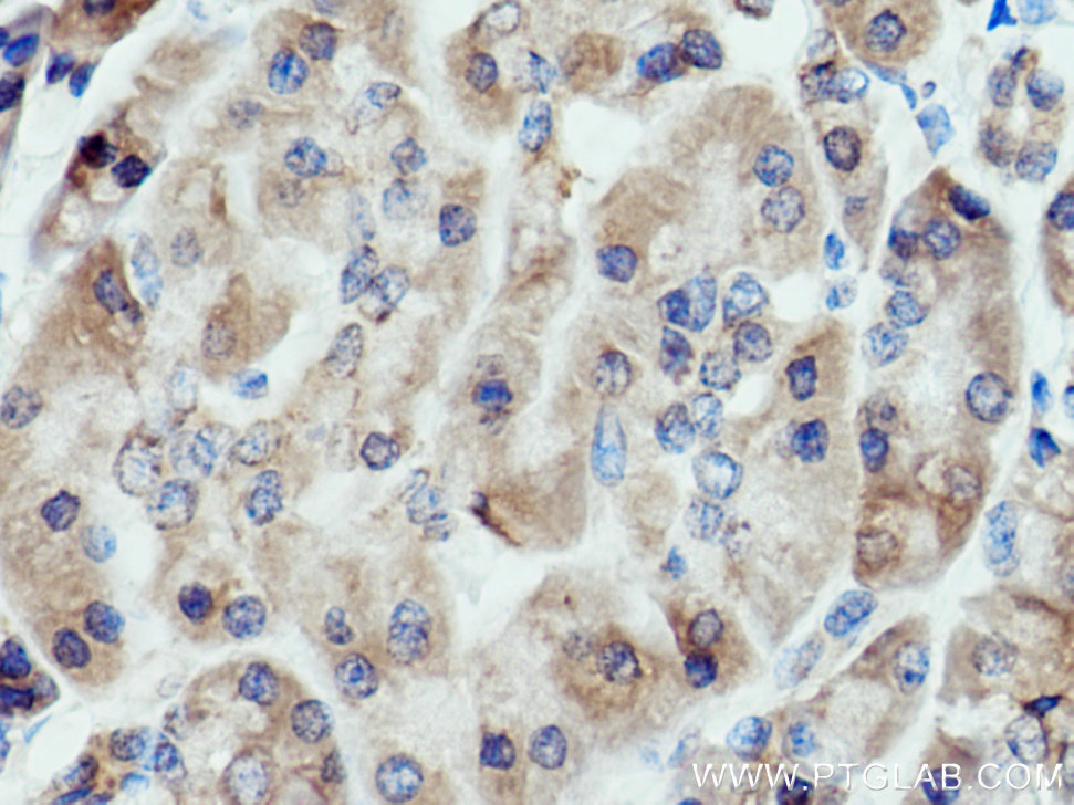 IHC staining of human pancreas cancer using 15092-1-AP