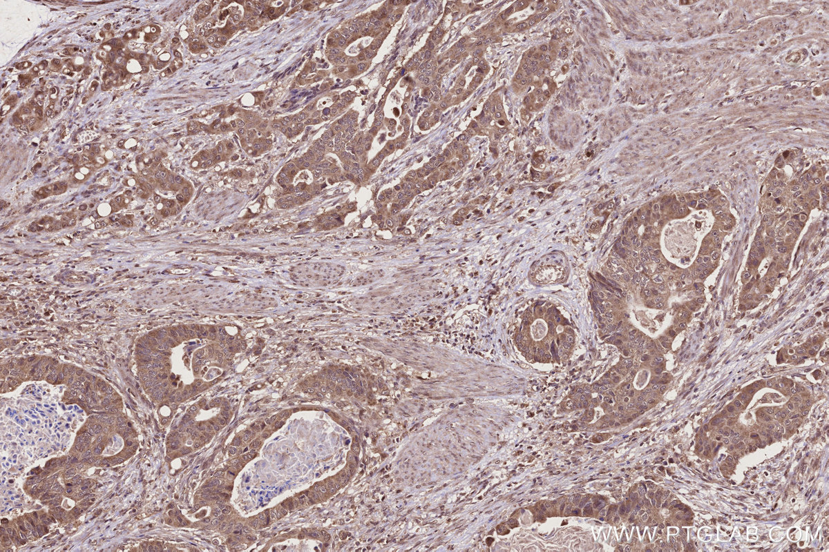 IHC staining of human stomach cancer using 28084-1-AP IHC staining of human stomach cancer using 28084-1-AP