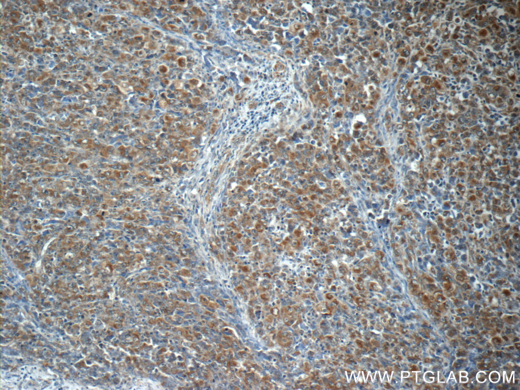 IHC staining of human lymphoma using 24184-1-AP