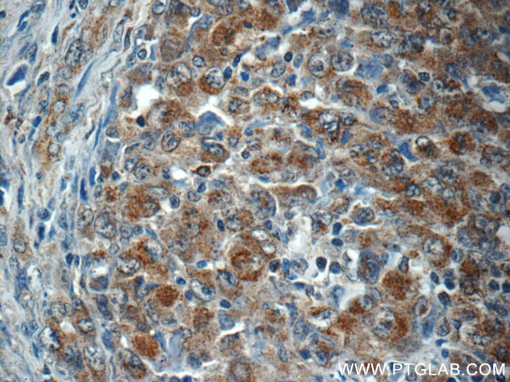 IHC staining of human lymphoma using 24184-1-AP