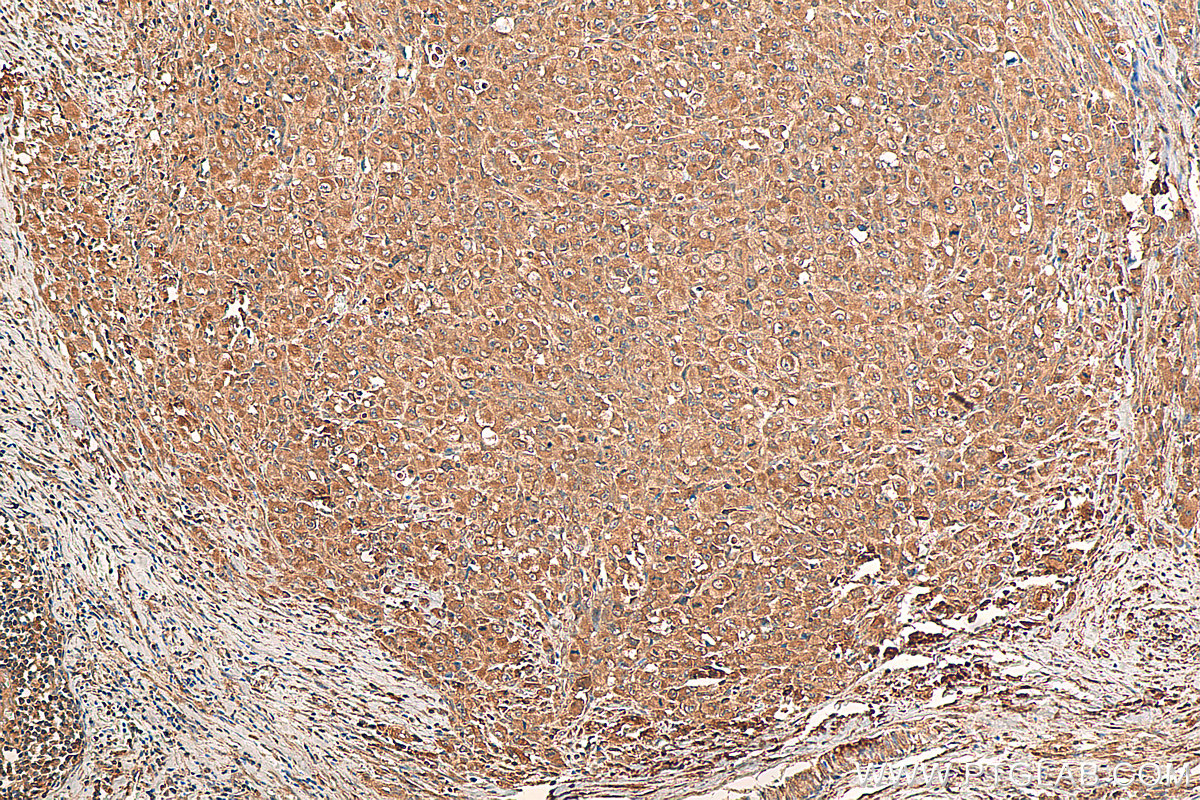 IHC staining of human lymphoma using 60321-1-Ig