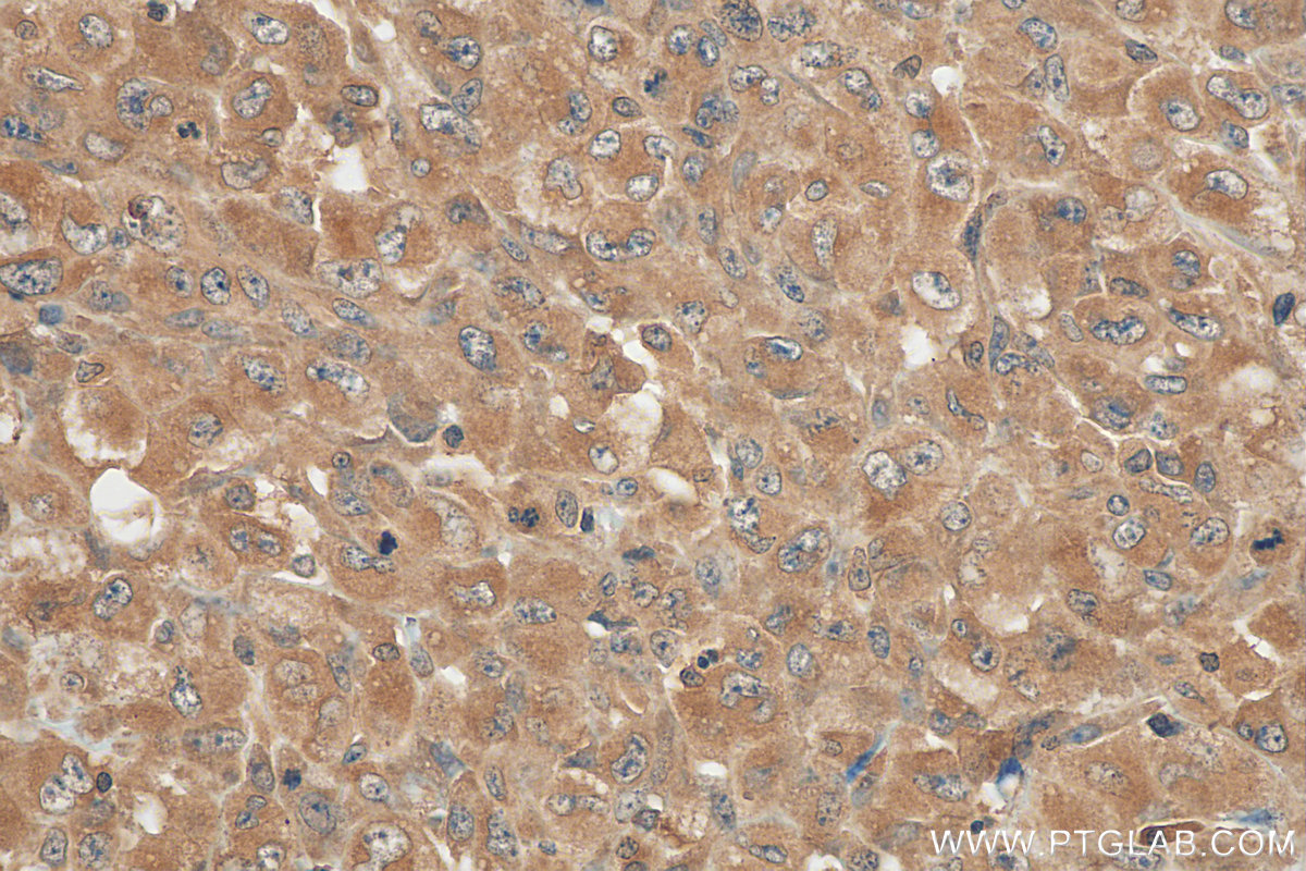 IHC staining of human lymphoma using 60321-1-Ig (same clone as 60321-1-PBS)