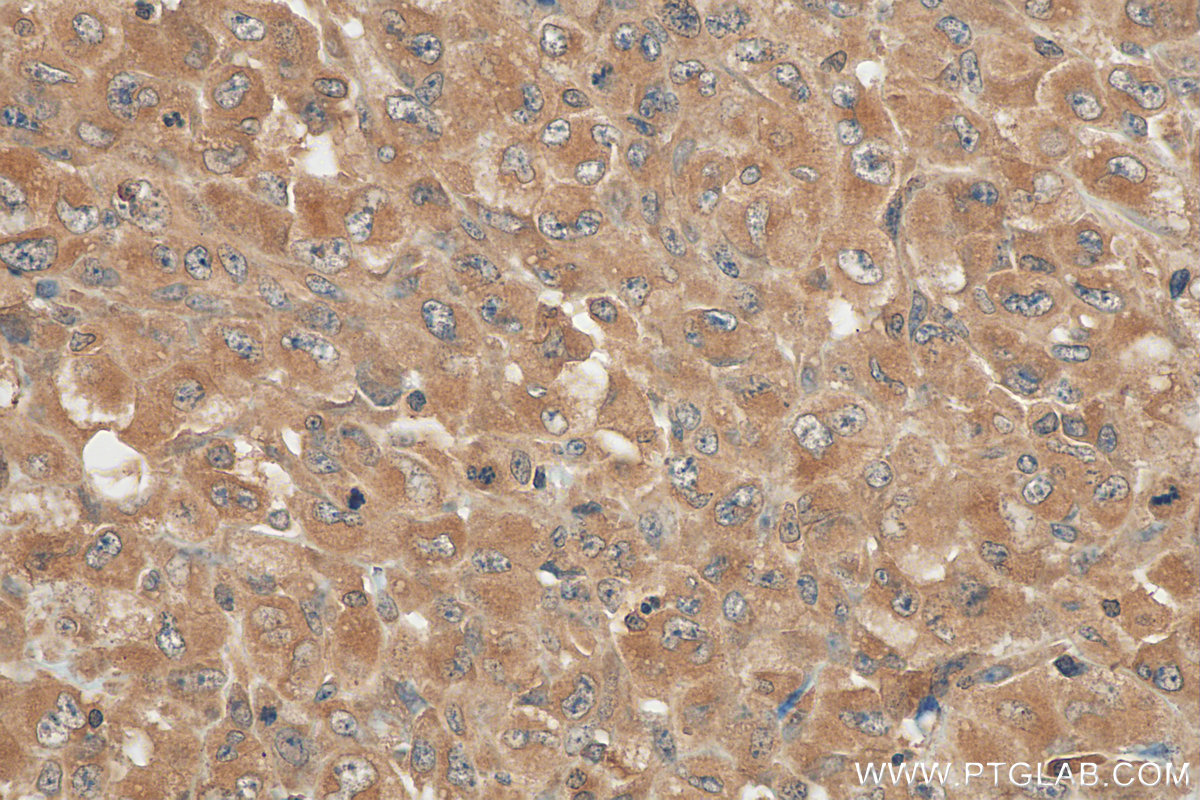 IHC staining of human lymphoma using 60321-1-Ig