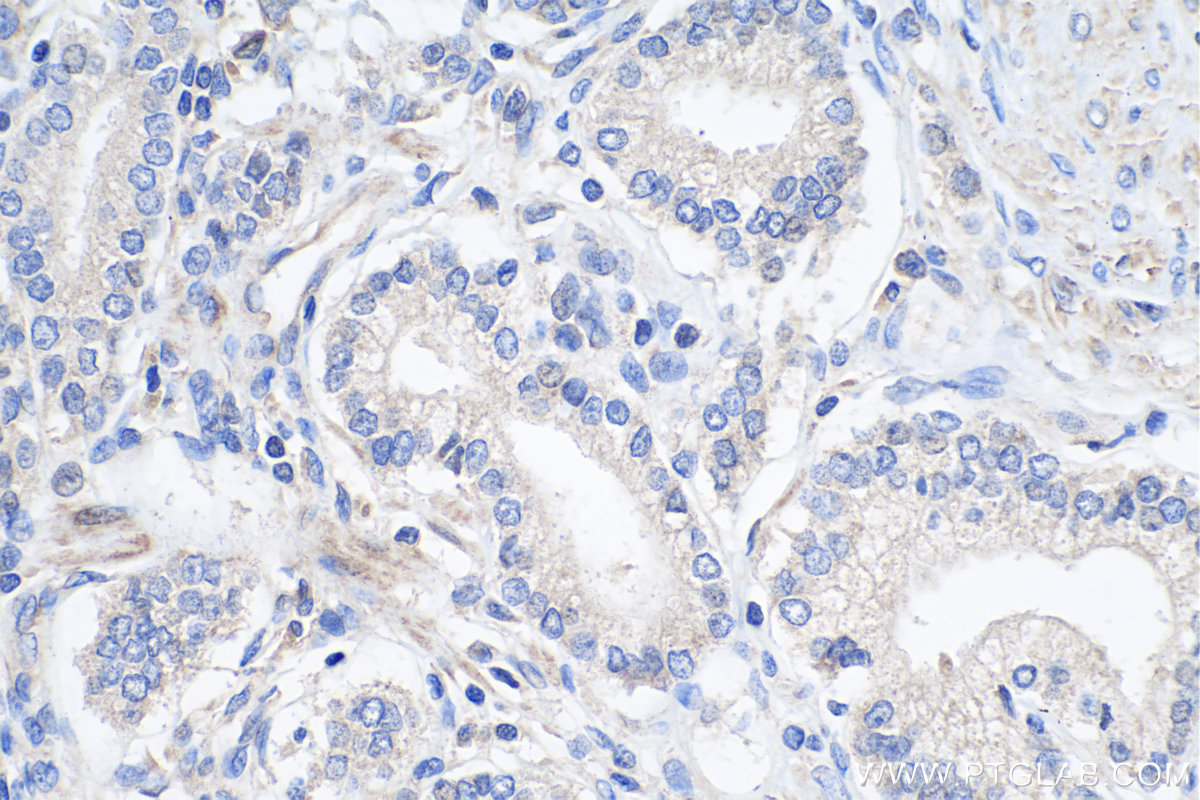 IHC staining of human prostate cancer using 12292-1-AP