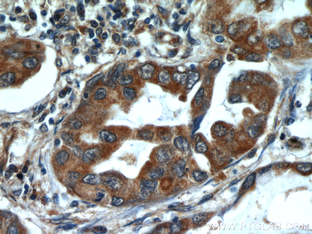 IHC staining of human lung cancer using 12292-1-AP