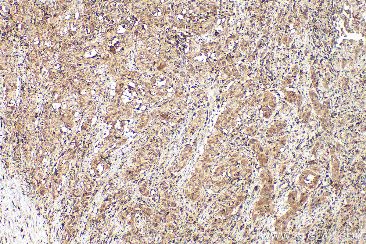 IHC staining of human lung cancer using 10021-1-Ig