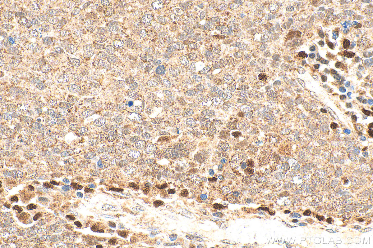 IHC staining of human ovary tumor using 10021-1-Ig