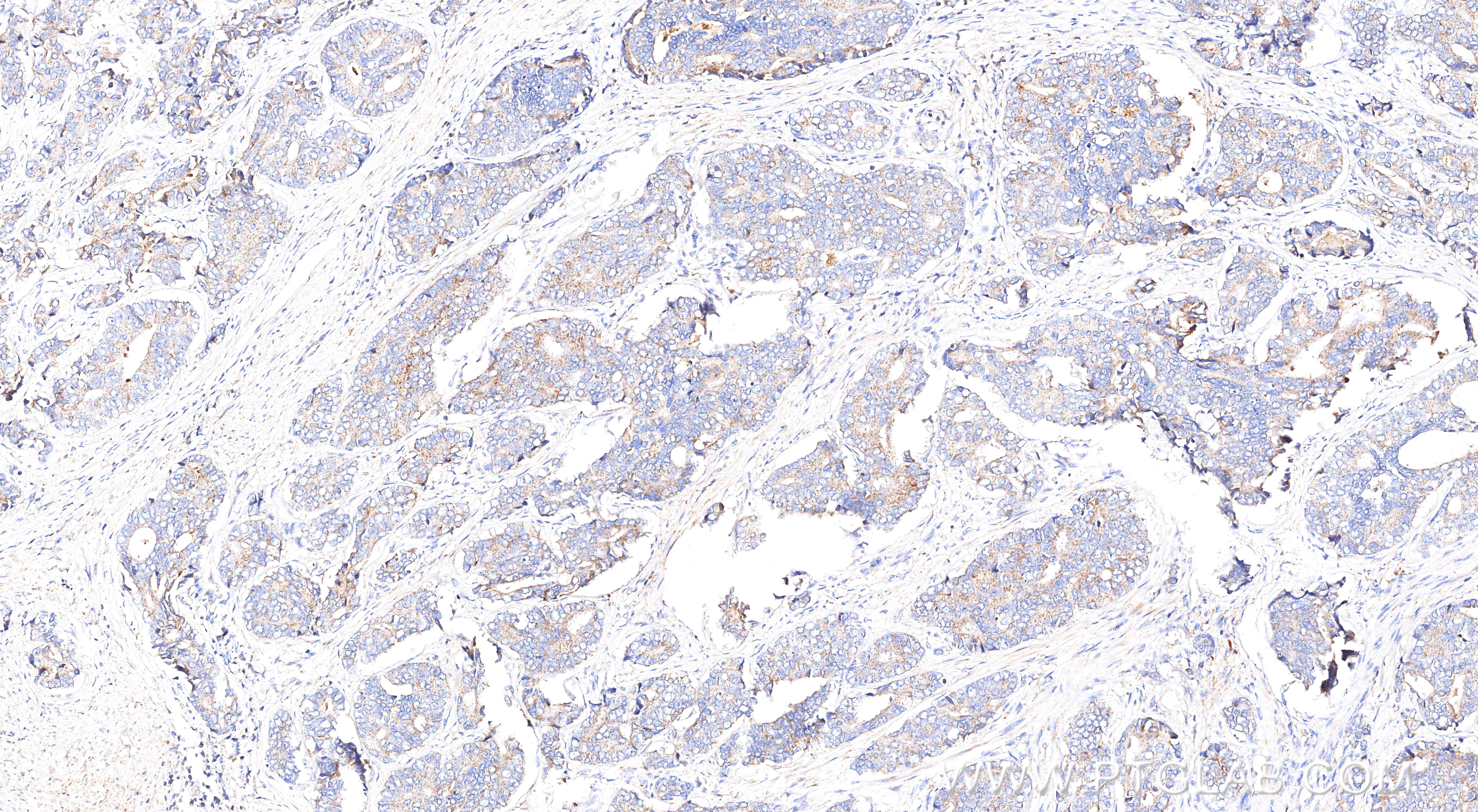 IHC staining of human prostate cancer using 84891-9-RR (same clone as 84891-9-PBS) IHC staining of human prostate cancer using 84891-9-RR (same clone as 84891-9-PBS)