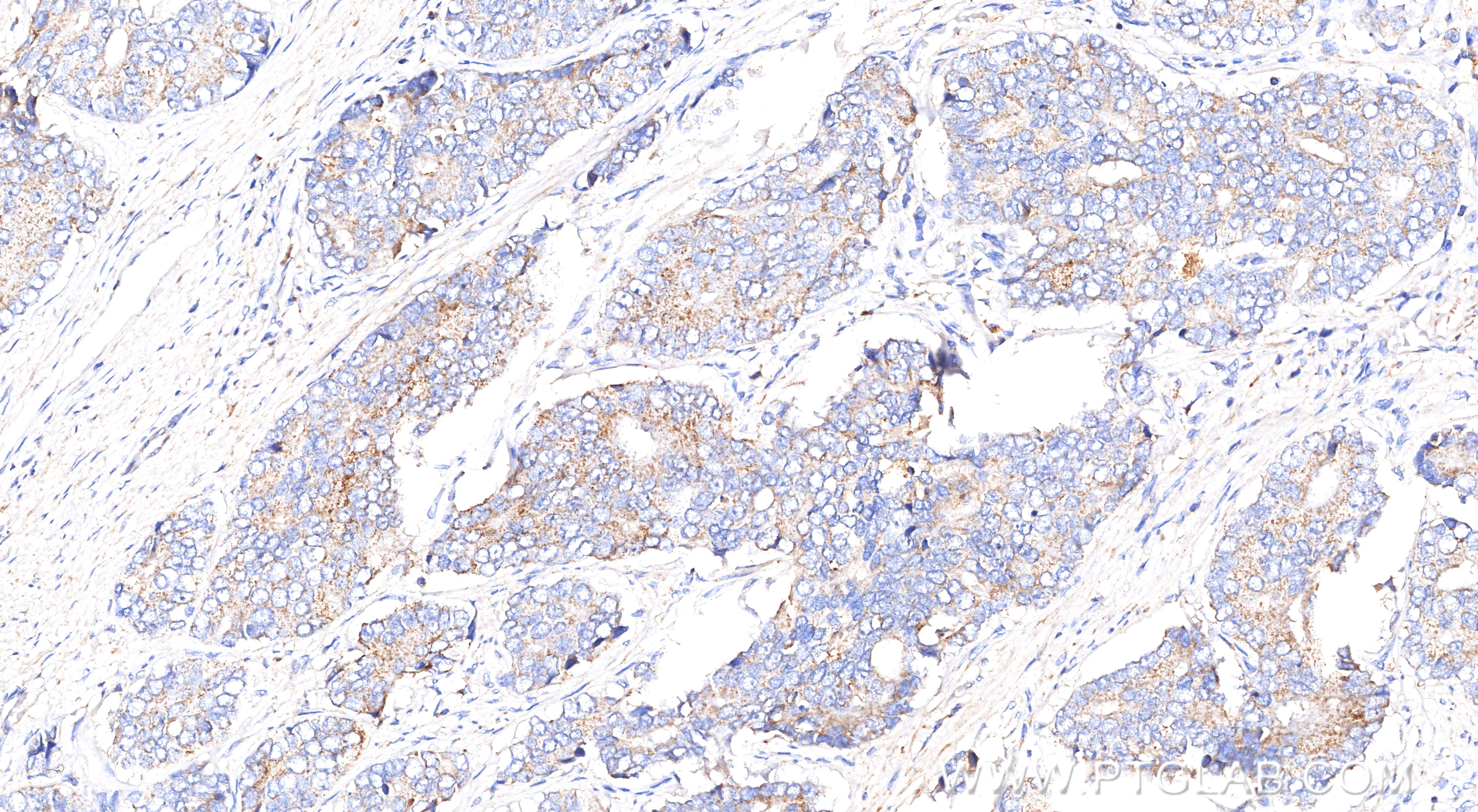 IHC staining of human prostate cancer using 84891-9-RR (same clone as 84891-9-PBS) IHC staining of human prostate cancer using 84891-9-RR (same clone as 84891-9-PBS)