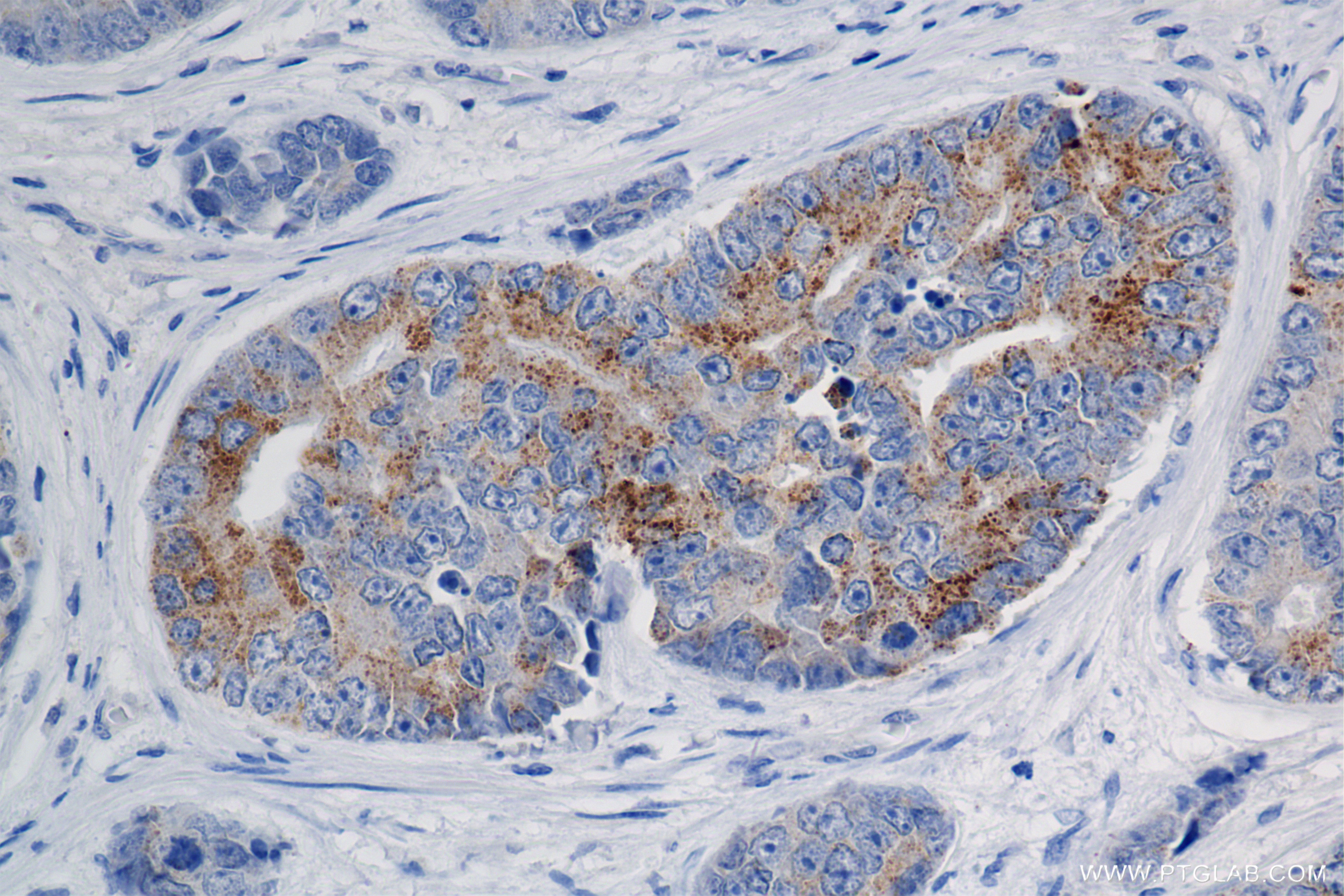 IHC staining of human prostate cancer using 84891-2-RR (same clone as 84891-2-PBS)