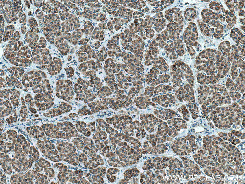 IHC staining of human liver cancer using 13762-1-AP