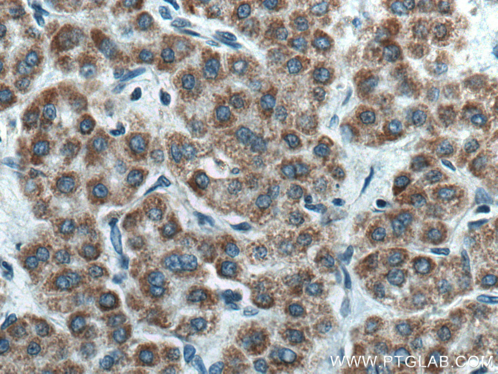 IHC staining of human liver cancer using 13762-1-AP