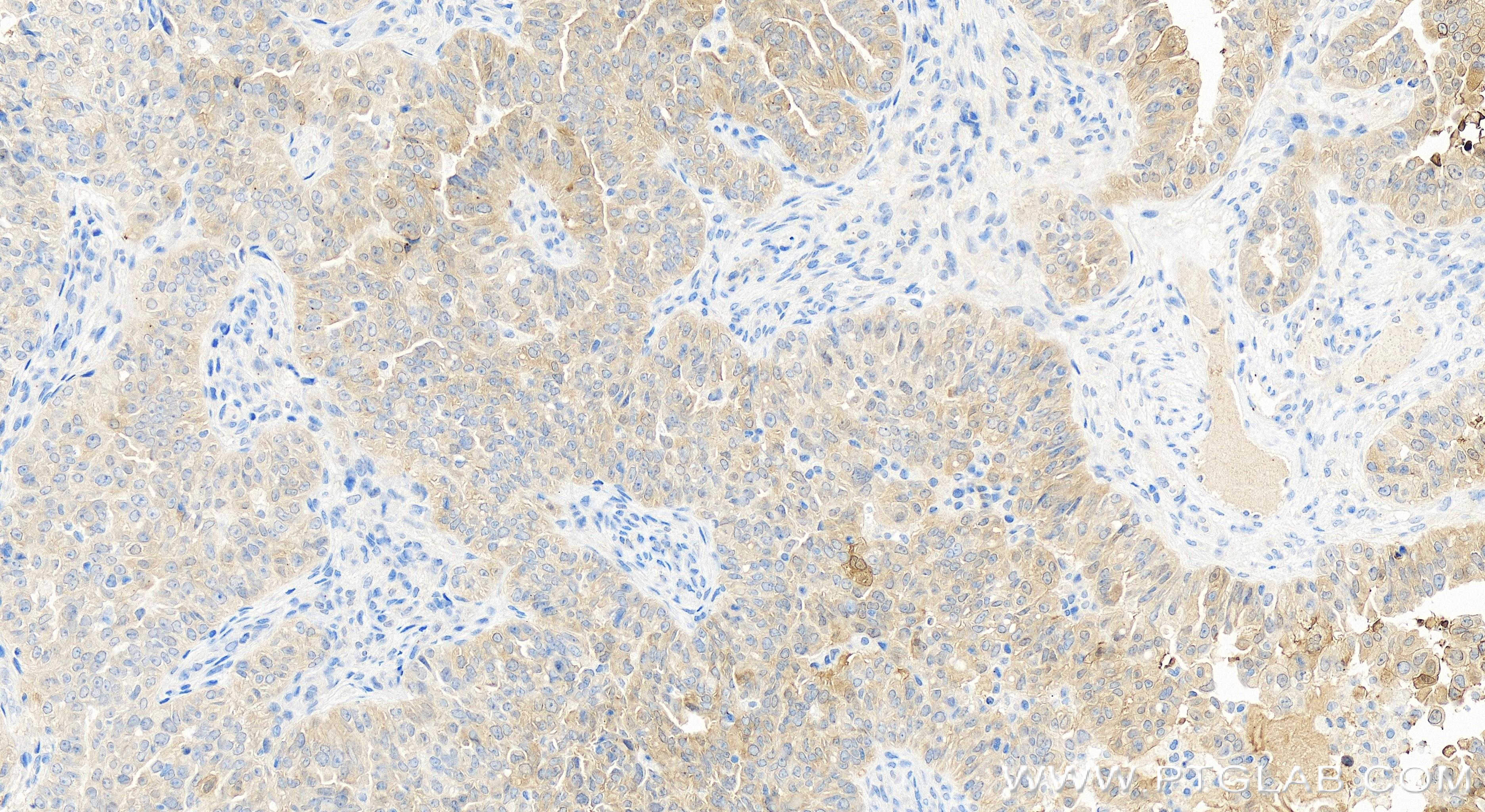 IHC staining of human ovary cancer using 84153-5-RR
