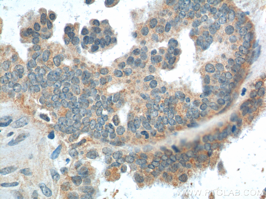 IHC staining of human ovary tumor using 25888-1-AP