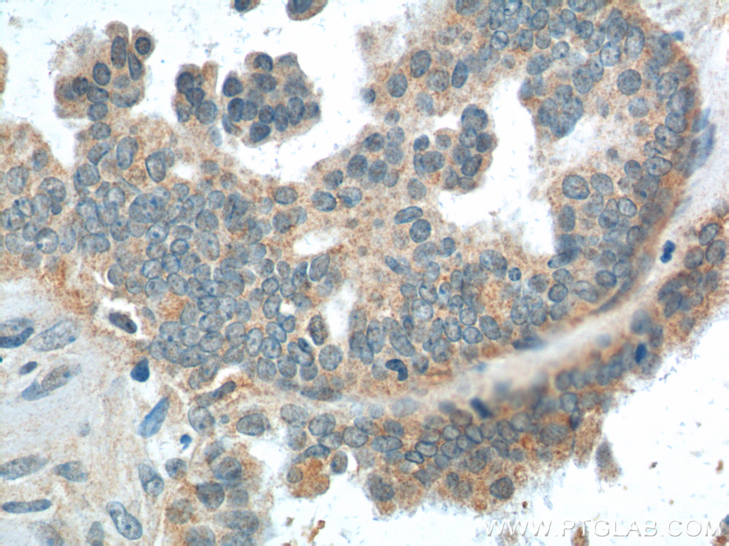 IHC staining of human ovary tumor using 25888-1-AP