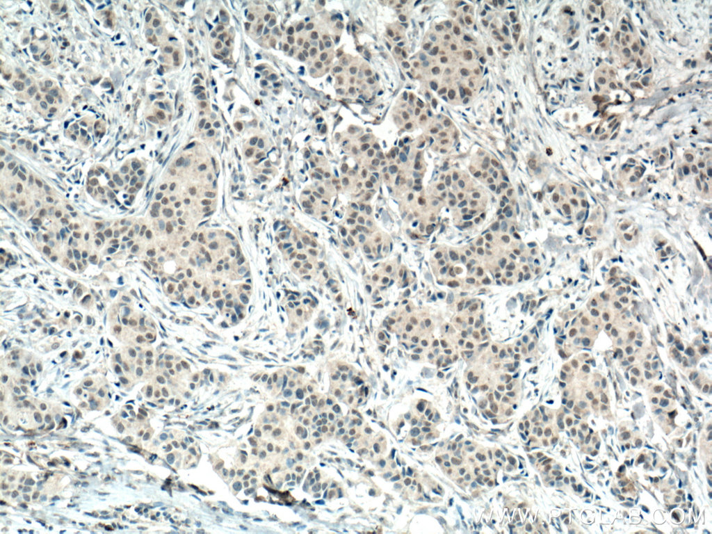 IHC staining of human breast cancer using 66536-1-Ig (same clone as 66536-1-PBS)