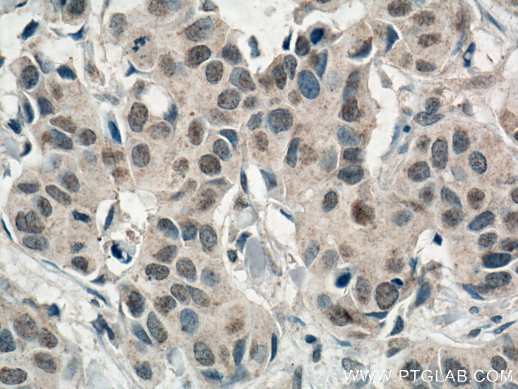 IHC staining of human breast cancer using 66536-1-Ig (same clone as 66536-1-PBS)