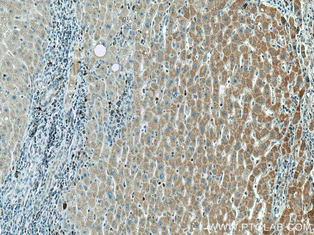 IHC staining of human liver cancer using 67532-1-Ig (same clone as 67532-1-PBS)
