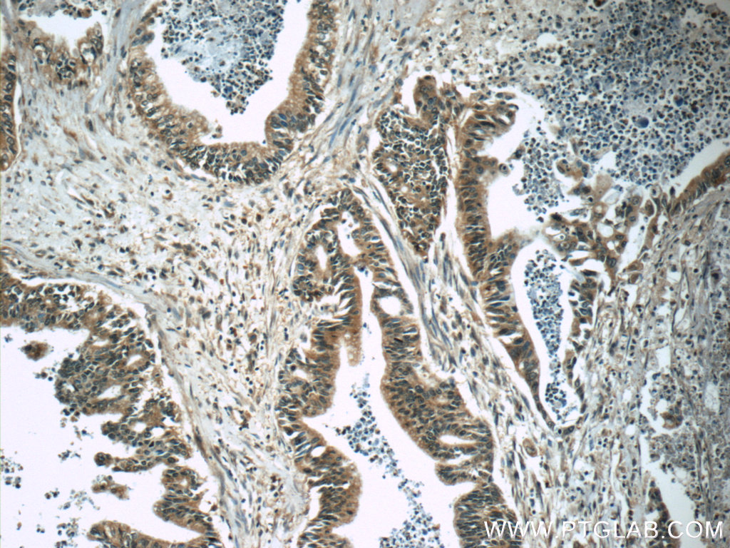 IHC staining of human pancreas cancer using 66133-1-Ig