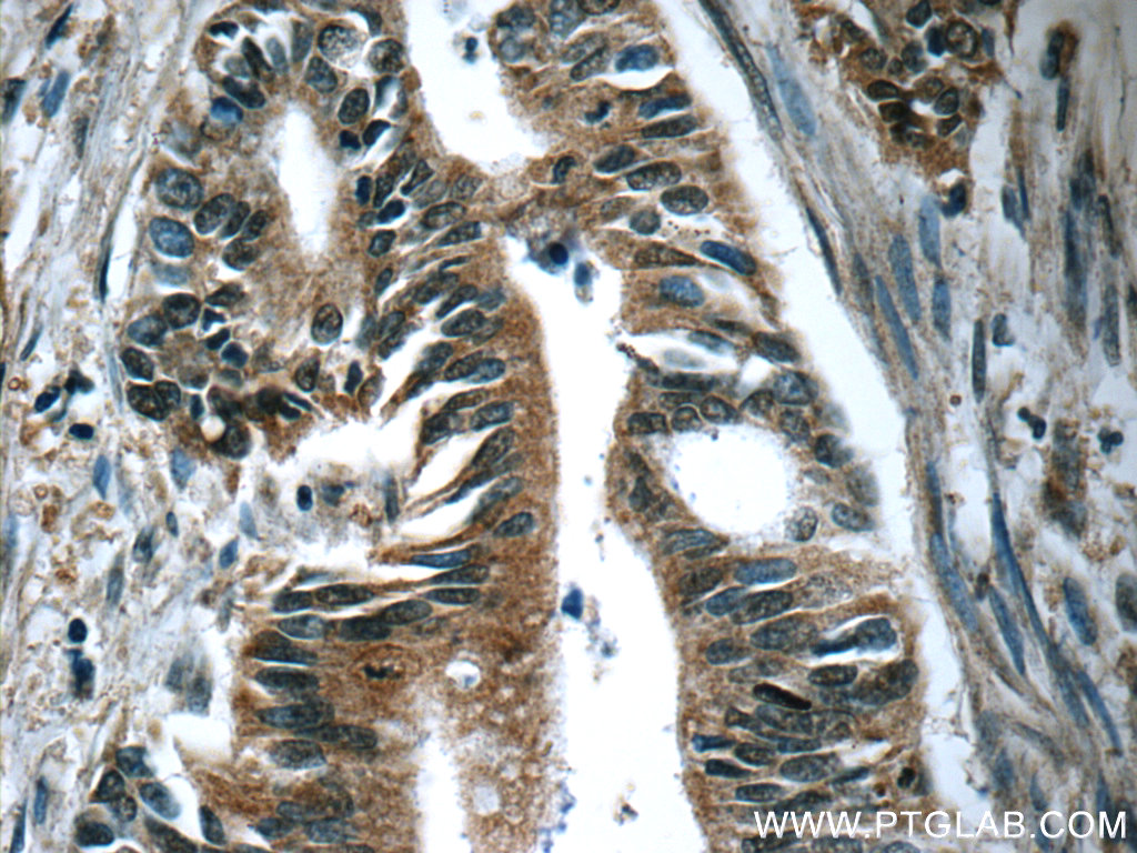 IHC staining of human pancreas cancer using 66133-1-Ig