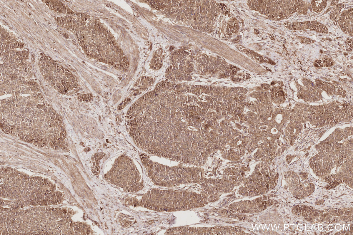 IHC staining of human stomach cancer using 21748-1-AP