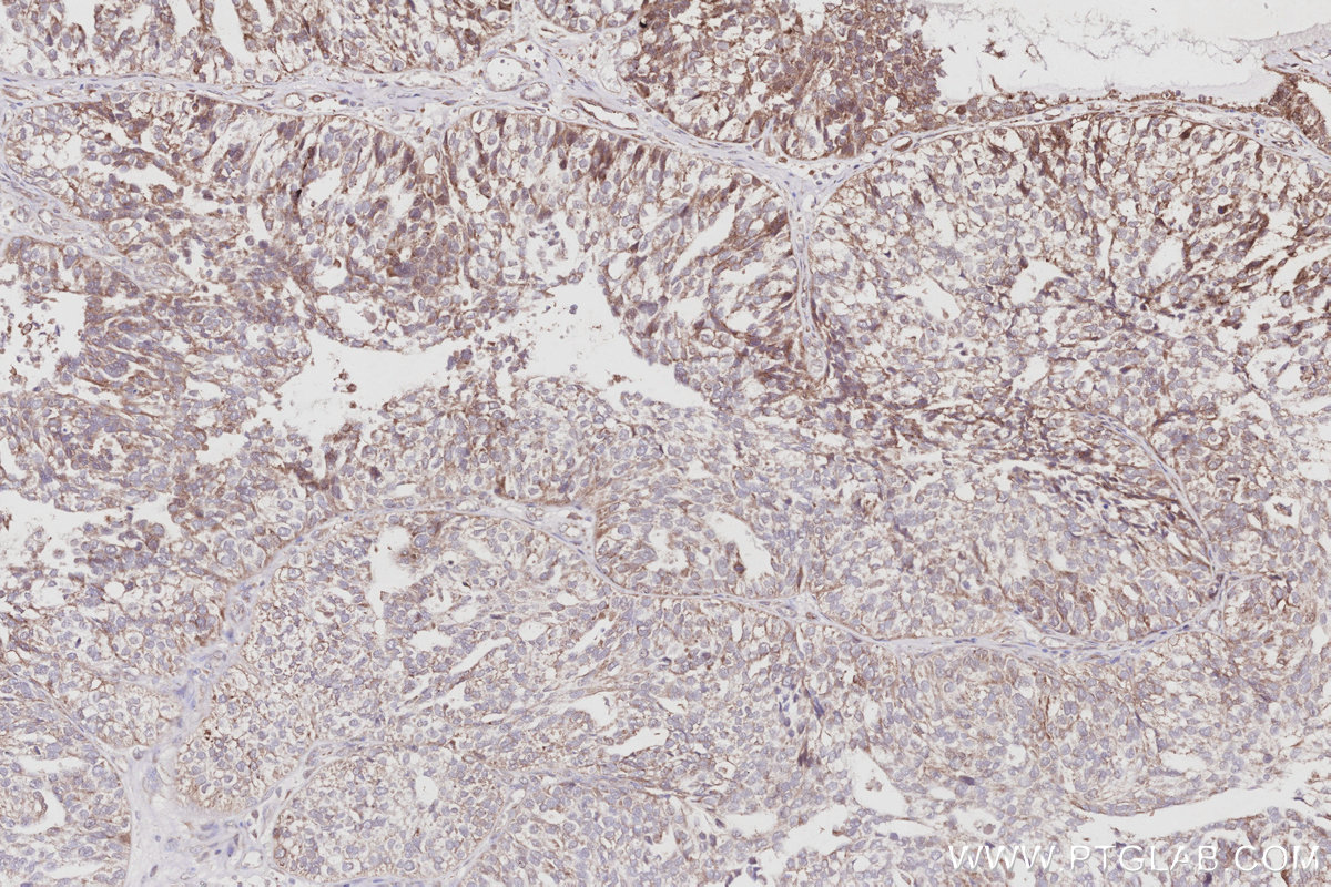 IHC staining of human ovary cancer using 15788-1-AP
