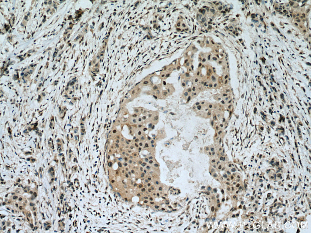 IHC staining of human breast cancer using 13559-1-AP