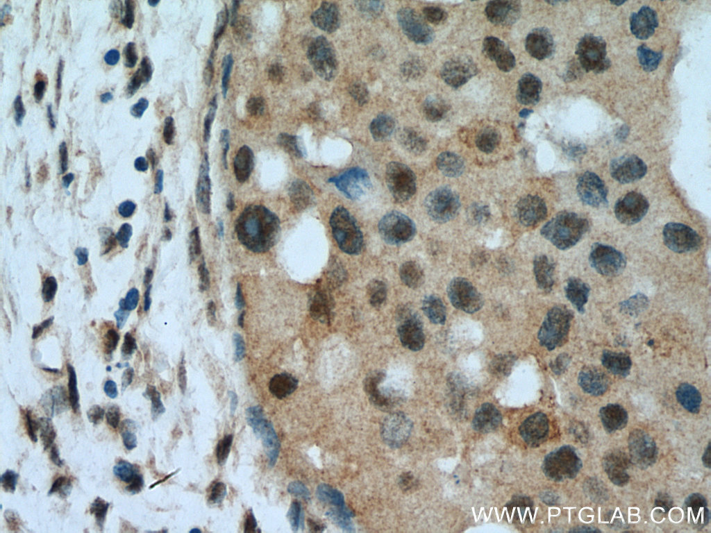 IHC staining of human breast cancer using 13559-1-AP