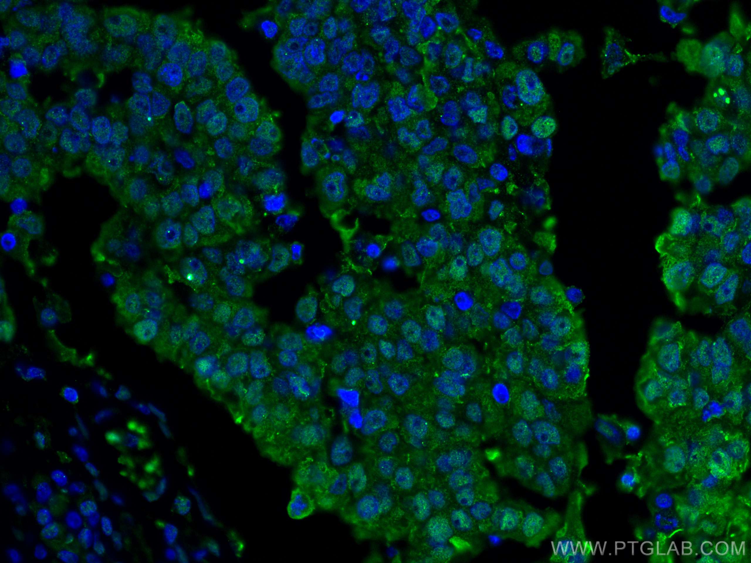 IF Staining of human breast cancer using 67348-1-Ig