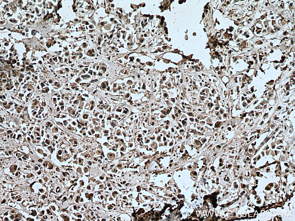 IHC staining of human breast cancer using 67348-1-Ig