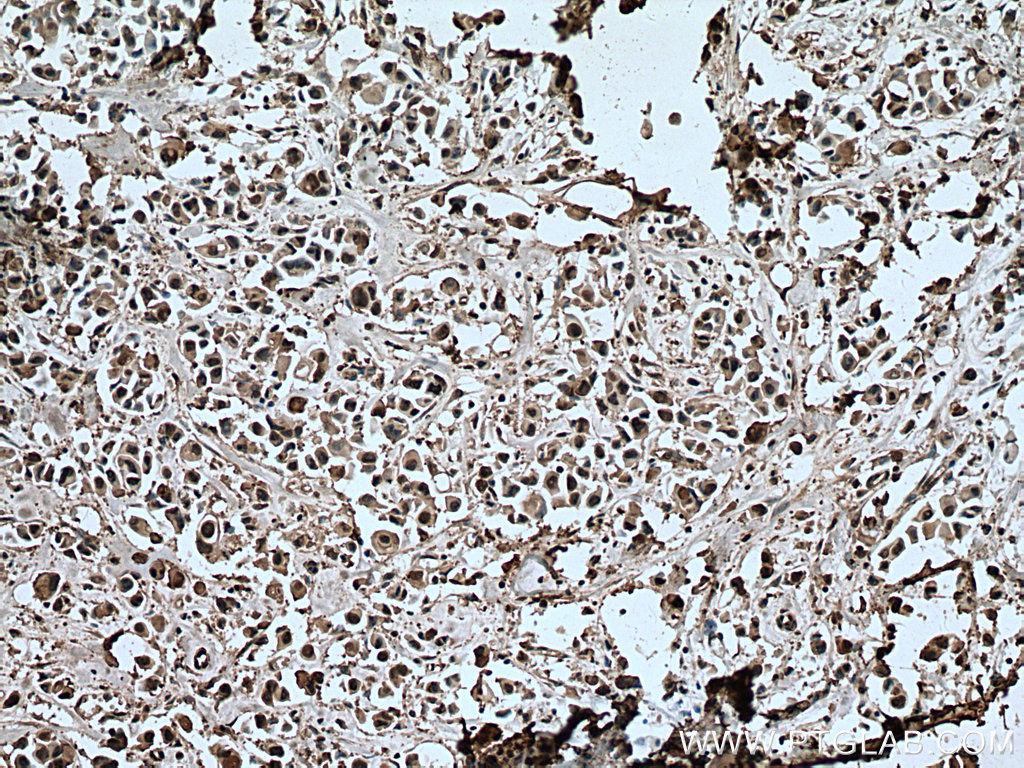 IHC staining of human breast cancer using 67348-1-Ig (same clone as 67348-1-PBS)