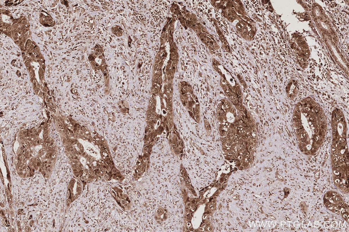IHC staining of human pancreas cancer using 67348-1-Ig IHC staining of human pancreas cancer using 67348-1-Ig