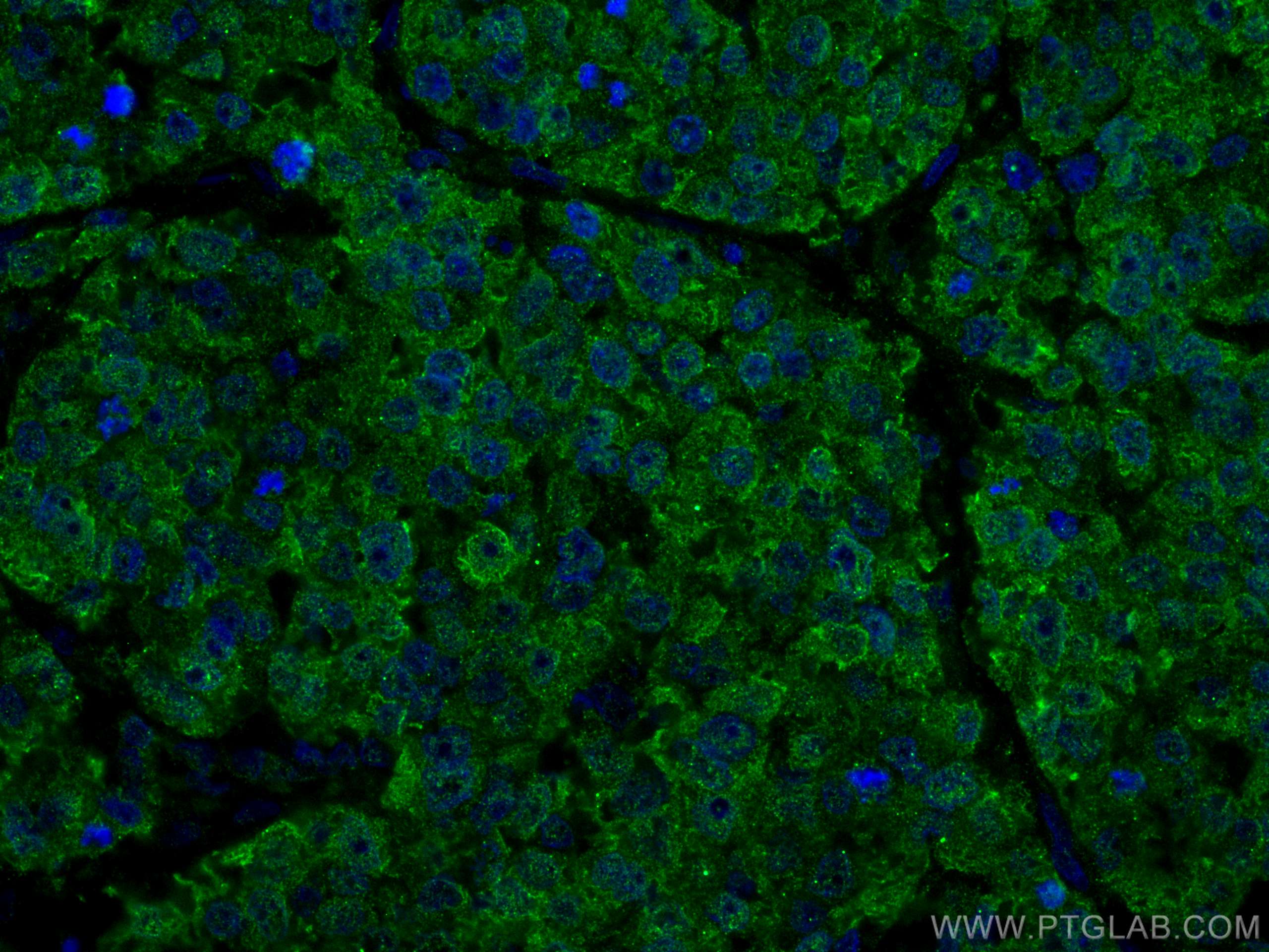 IF Staining of human breast cancer using CL488-67348