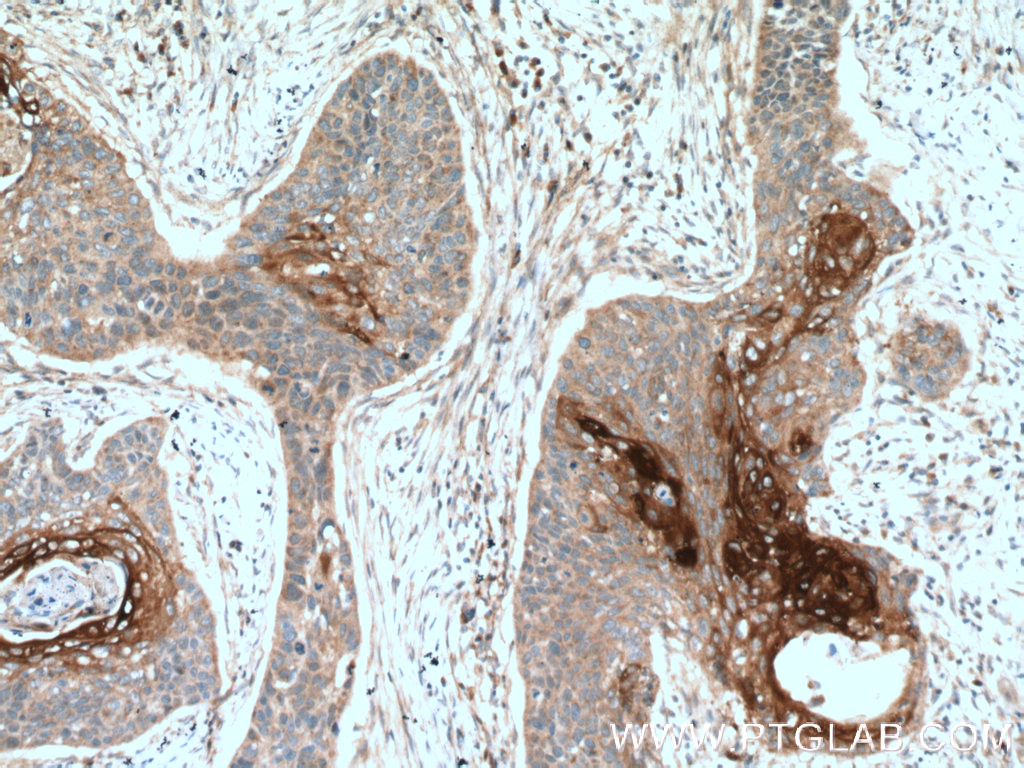 IHC staining of human oesophagus cancer using 18374-1-AP