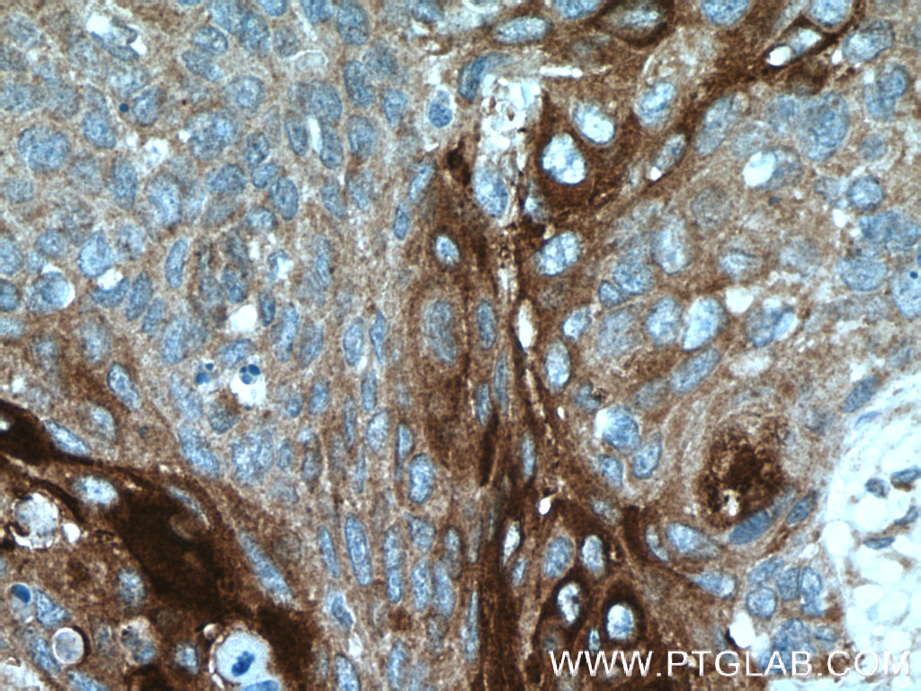 IHC staining of human oesophagus cancer using 18374-1-AP