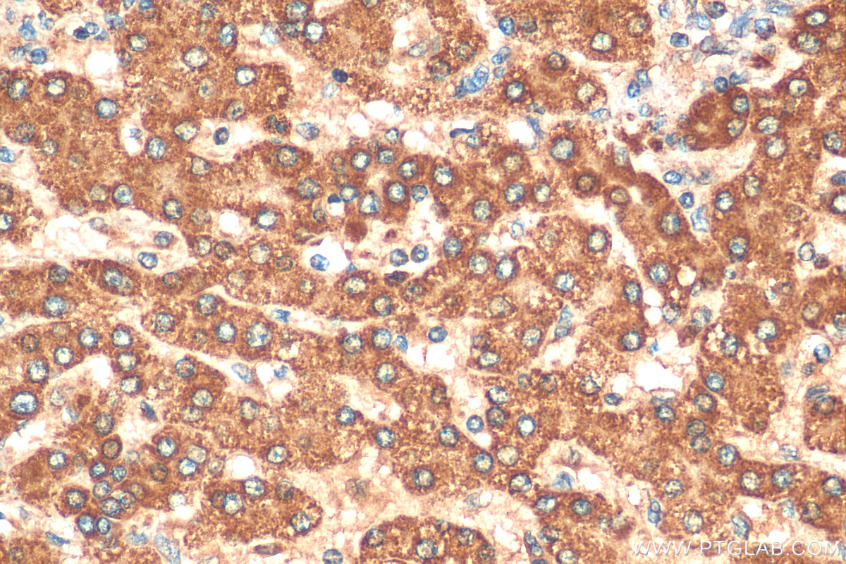 IHC staining of human liver cancer using 10396-1-AP