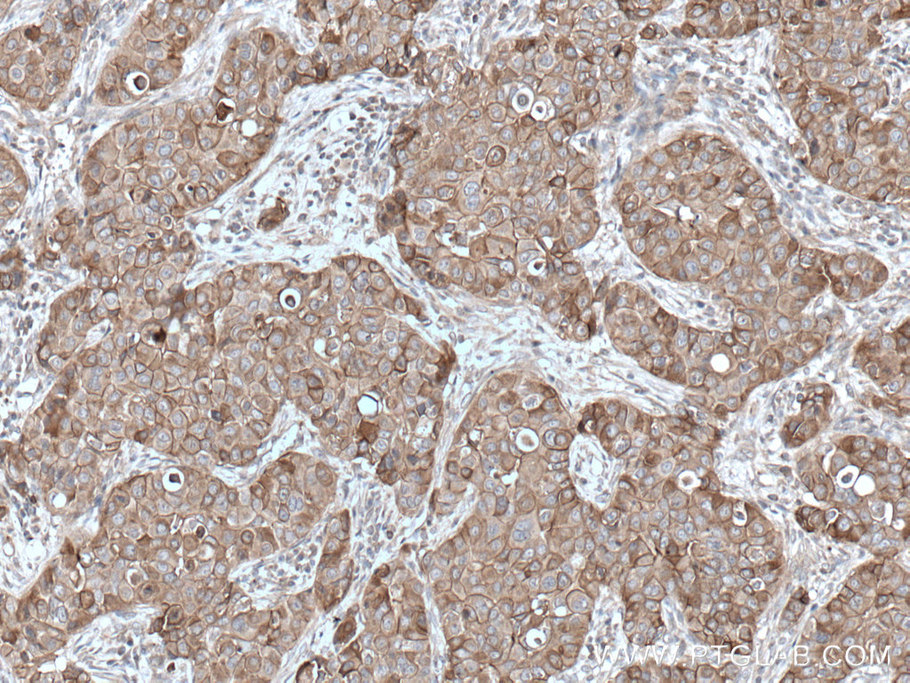 IHC staining of human breast cancer using 27980-1-AP